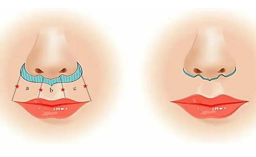 Хирургическая коррекция верхней губы. Булхорн.